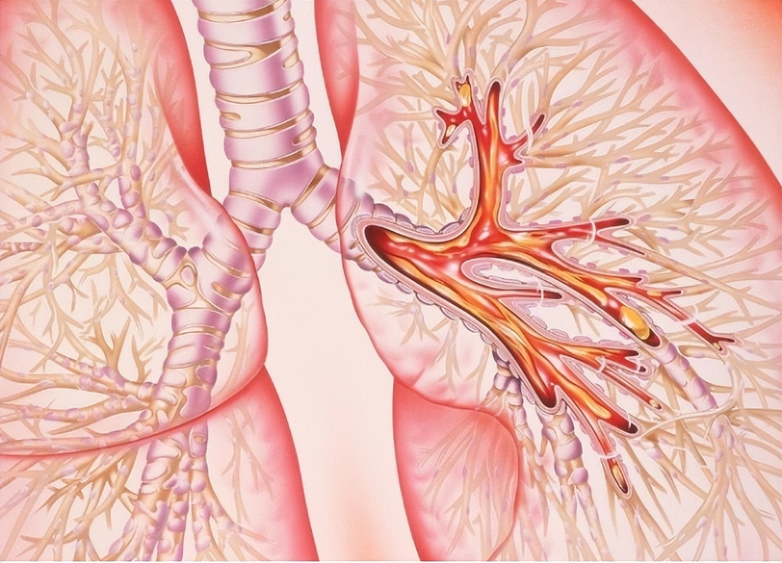 宝妈支气管发炎怎么办,宝妈得了支原体肺炎怎么办