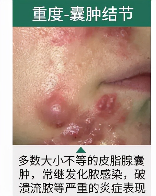青春痘变疮了要怎么治,治脓包型青春痘偏方