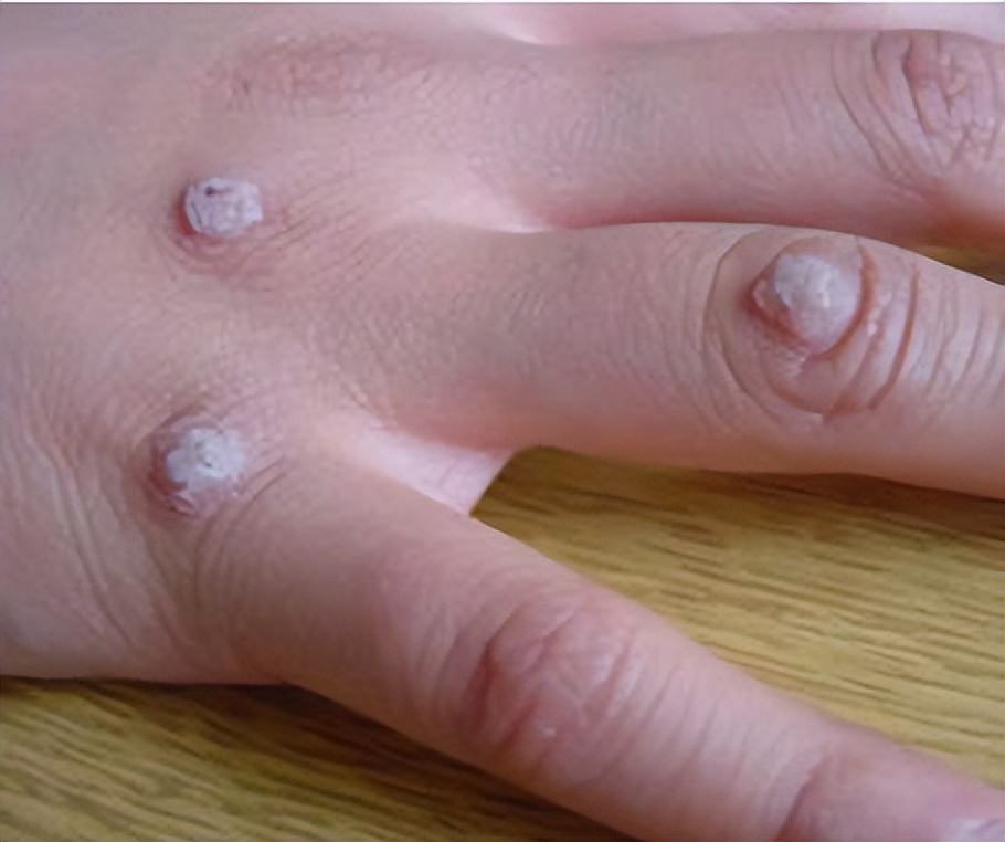 手上、脸上的“肉疙瘩”哪些是HPV导致的？6种常见疣的区分和治疗