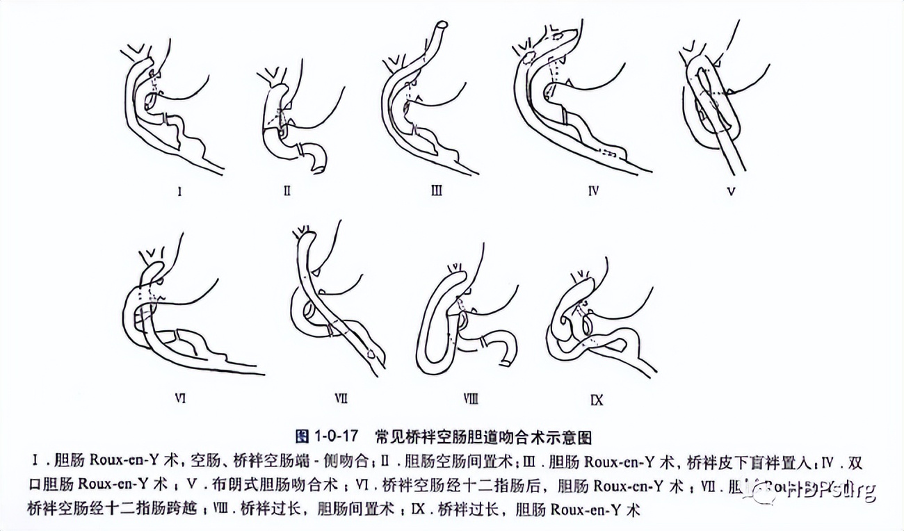 关于肝胆管结石治疗的入肝途径的总结