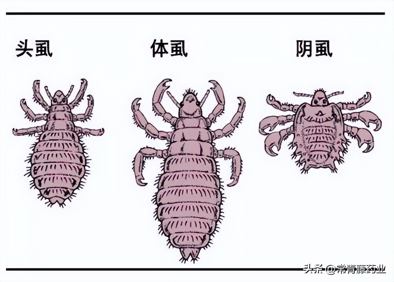 阴虱感染特别严重后如何治疗,怎样预防阴虱的传播