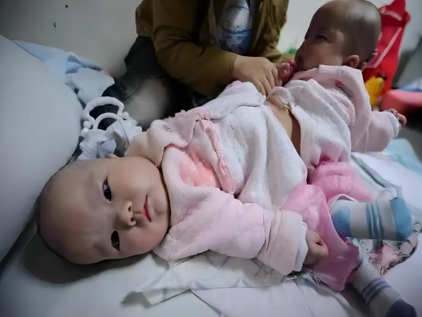 女子生出怪胎真实案件,湖北女子生下连体婴儿如今怎样了