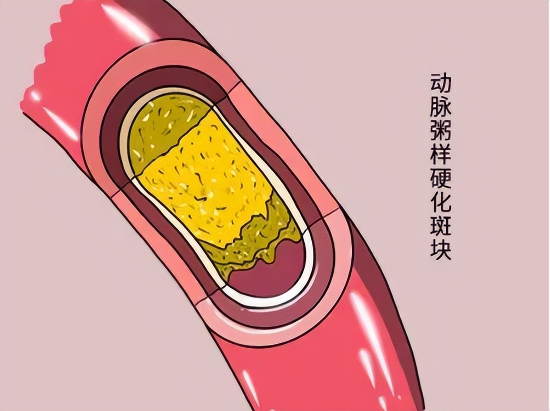 冠心病诊断预测模型,建模预测冠心病