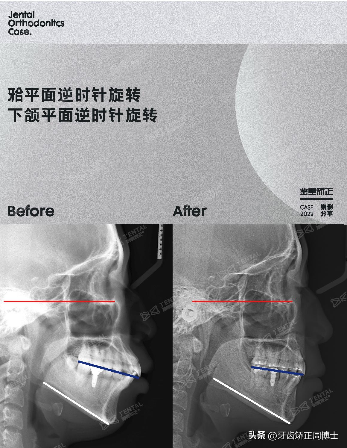 骨性前突正畸后多长时间有效果,牙性下巴后缩可以戴牙套改善吗