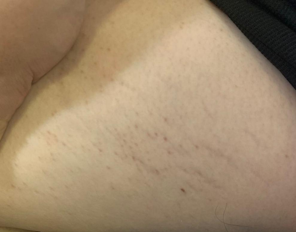 肥胖纹目前最好的去除办法,淡化肥胖纹修复肥胖纹