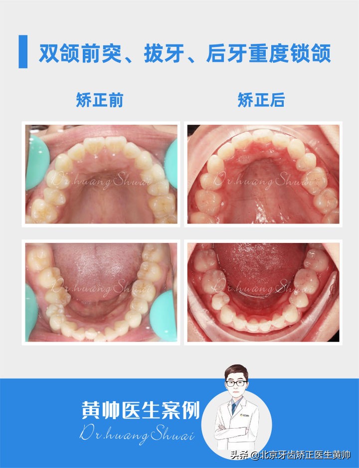 嘴凸的人怎么笑起来好看,嘴型比较凸的人怎么改善
