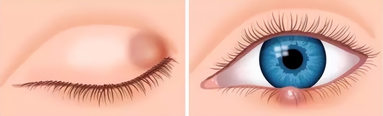 孩子长了针眼红肿出头了怎么处理,小儿针眼起脓包怎么办