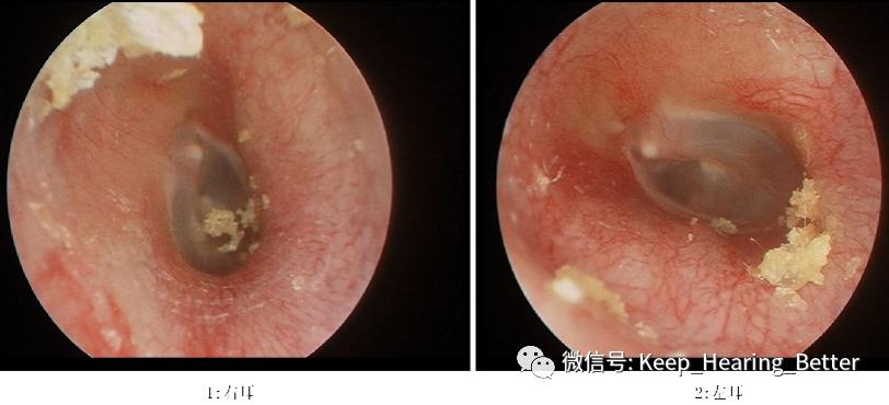 南昌大学二附院耳喉科,耳膜硬化症是什么样子