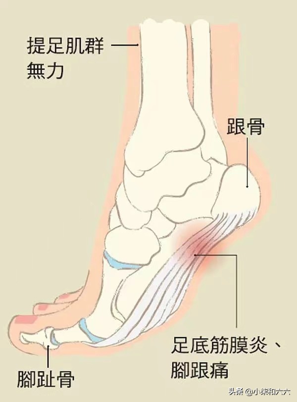 老年人足跟疼痛是什么原因,足跟小腿后侧疼痛难忍是什么原因