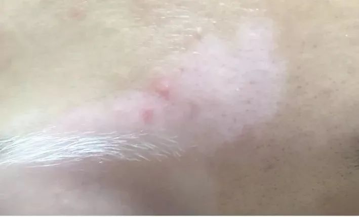 白癜风与伤口变白的区别,伤口变白斑是怎么回事