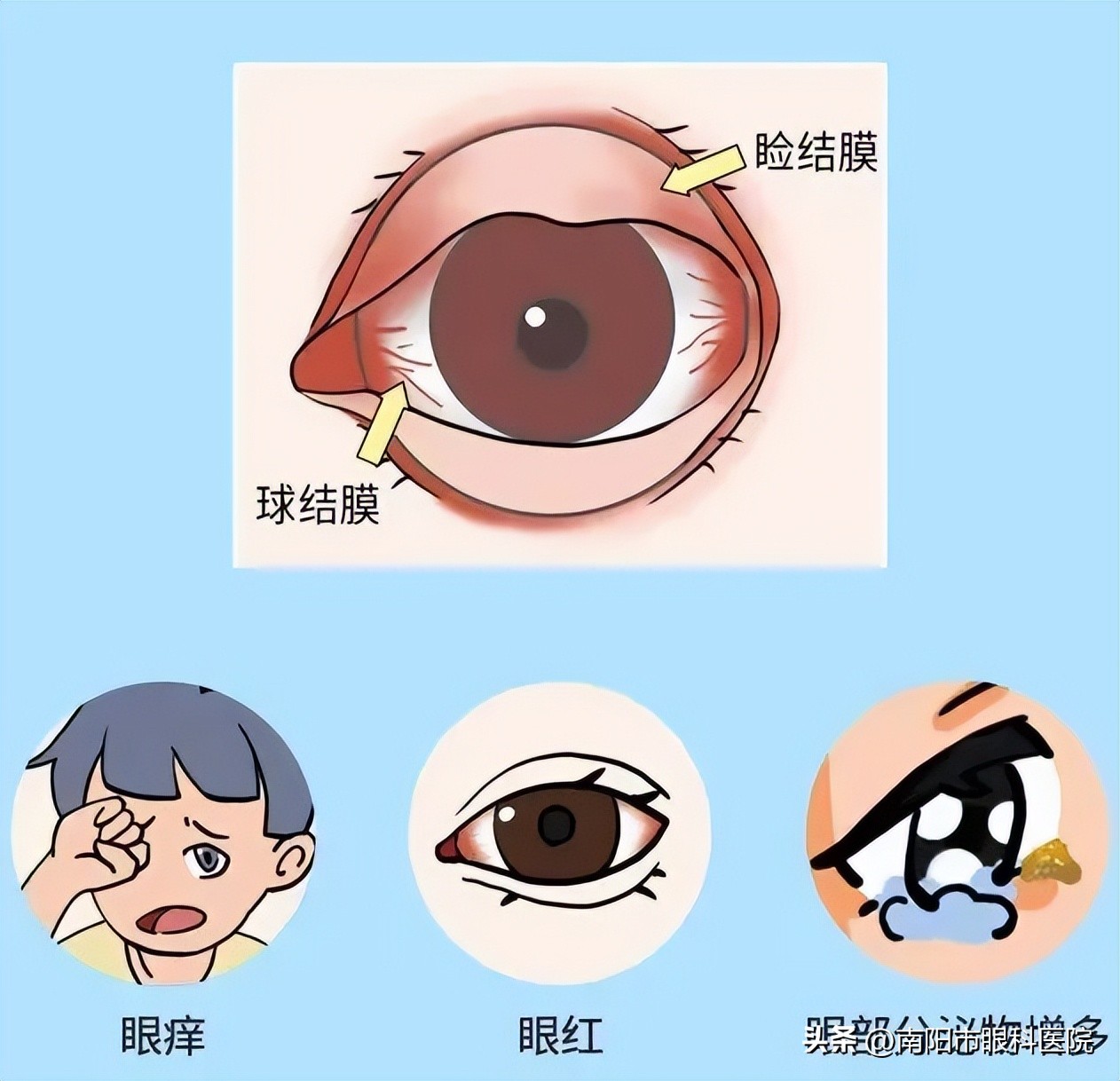 新冠病毒诱发结膜炎怎么治疗,如何预防眼结膜感染新冠病毒