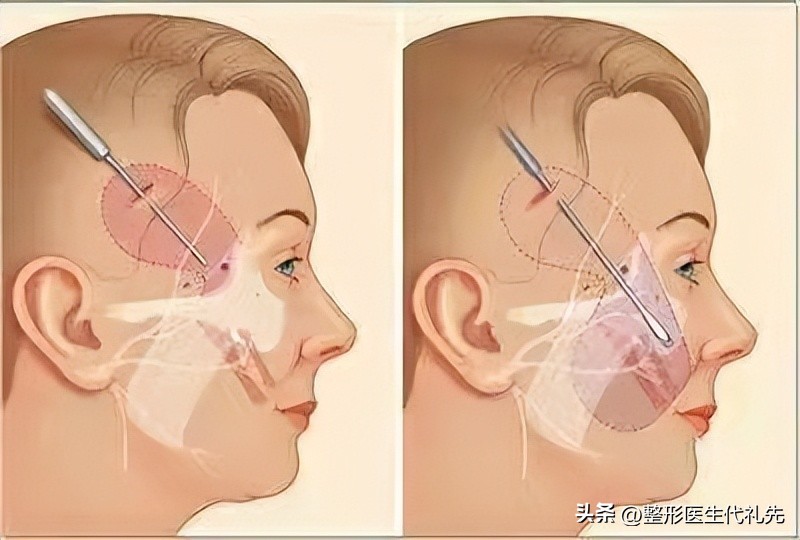 面部抗衰老的黄金三步（医生总结），40~50~60不同年龄阶段抗衰老
