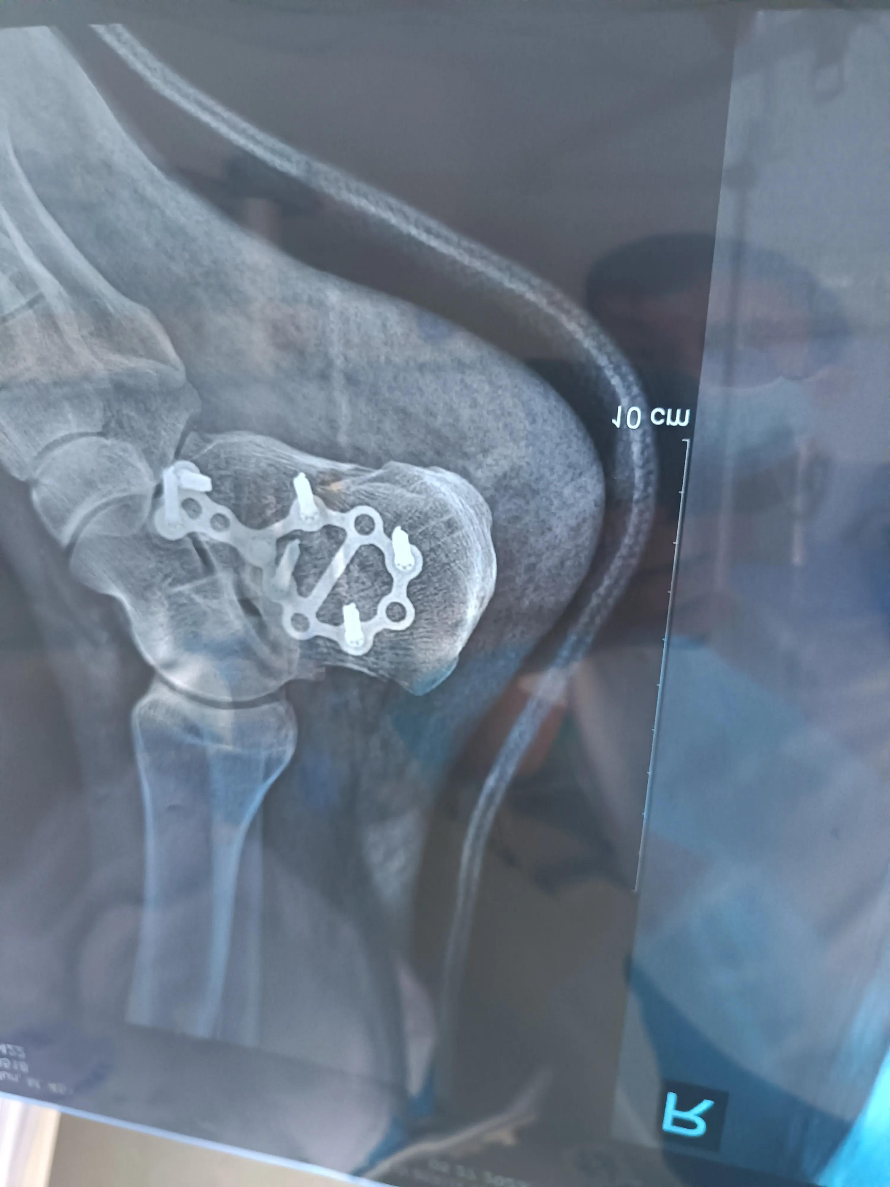 物流公司打工出了工伤事故归哪管,货运公司上班途中外出受伤算工伤