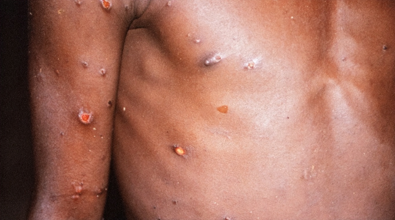 卑诗省有2例猴痘患者？省府回应来了脓肿溃烂目前无药可治