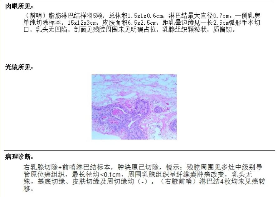 联合检查达到的效果,合并导管原位癌