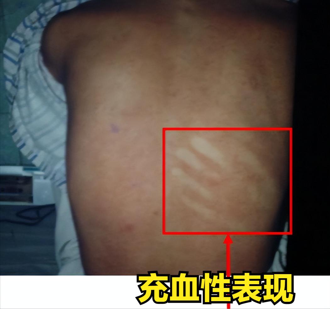 预防控制登革热最佳的措施是灭蚊,登革热的症状及预防措施