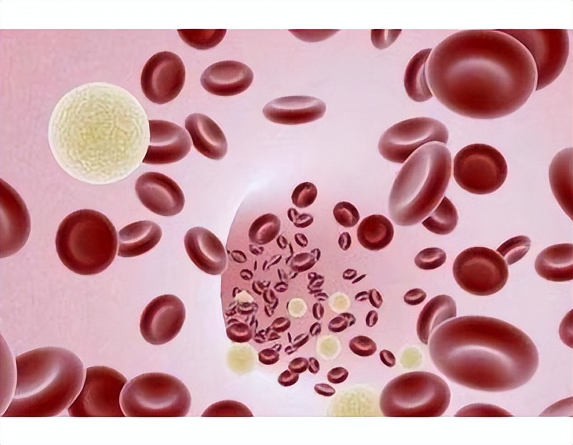 预防血栓吃50毫克阿司匹林够用吗,90岁大爷预防血栓的7个步骤