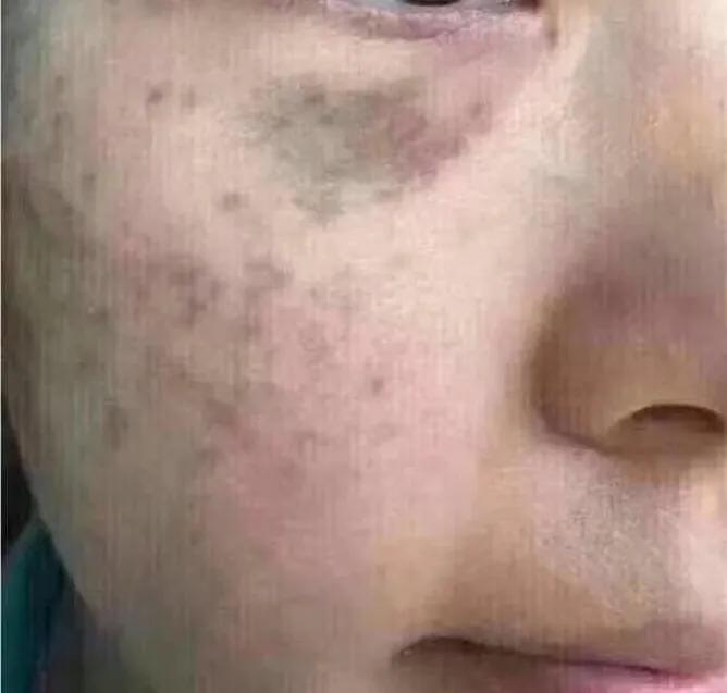 色斑怎么分辨,色斑的种类及鉴别诊断