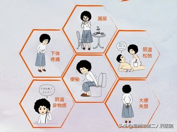 盆底康复呵护女性,如何预防盆底肌疾病