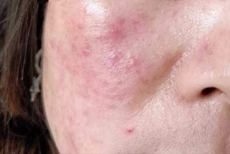面部皮炎的症状和治疗方法,面部皮炎是怎么回事
