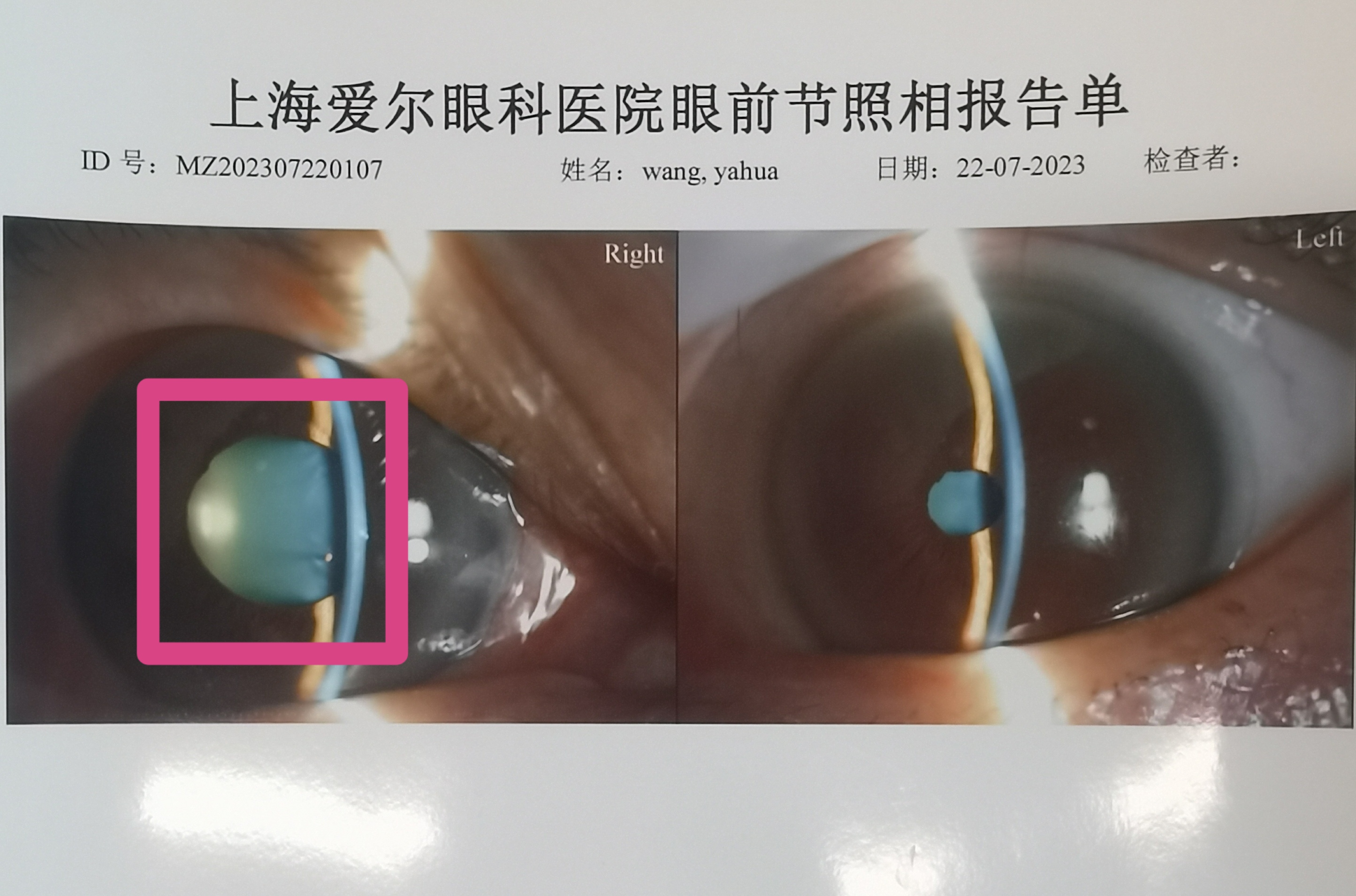 眼痛头疼视力下降别大意，周末24小时绿色通道挽救急性青光眼光明