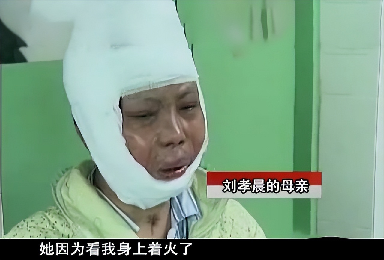 女子因为火灾毁容,女子因火灾而毁容