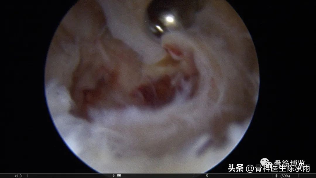 内侧半月板前角囊肿,关节镜下内侧半月板部分切除术