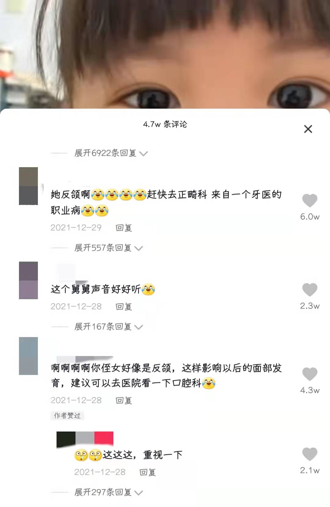 反颌危害,儿童牙齿反颌有什么危害