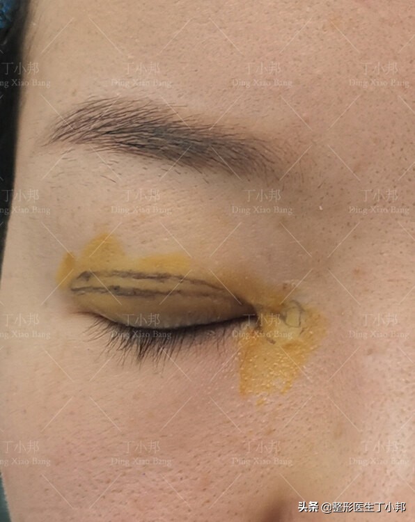 开眼角又长回去怎么办,开眼角可以留一点内眦赘皮吗