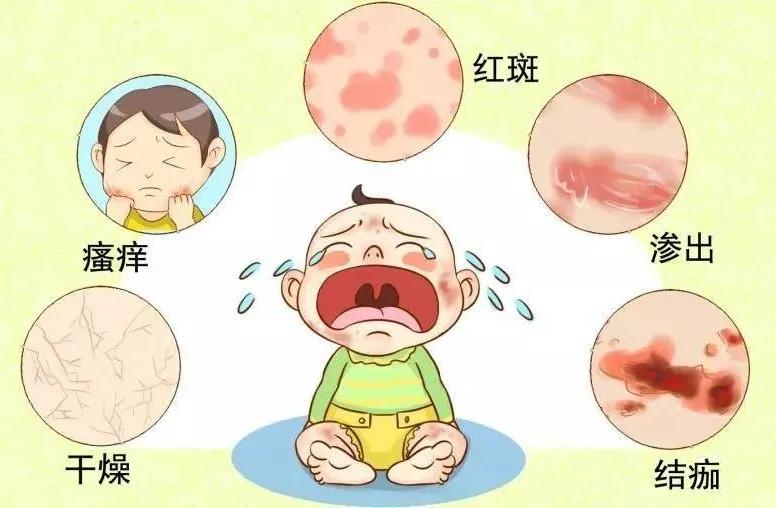 湿疹忌口会影响母乳质量吗,婴儿脸上长湿疹母乳应忌口什么