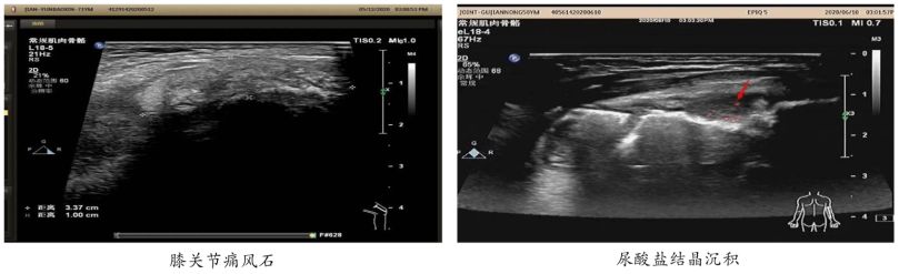 痛风反复发作教你一招让痛风缓解,痛风反复发作别乱治试试这个方法