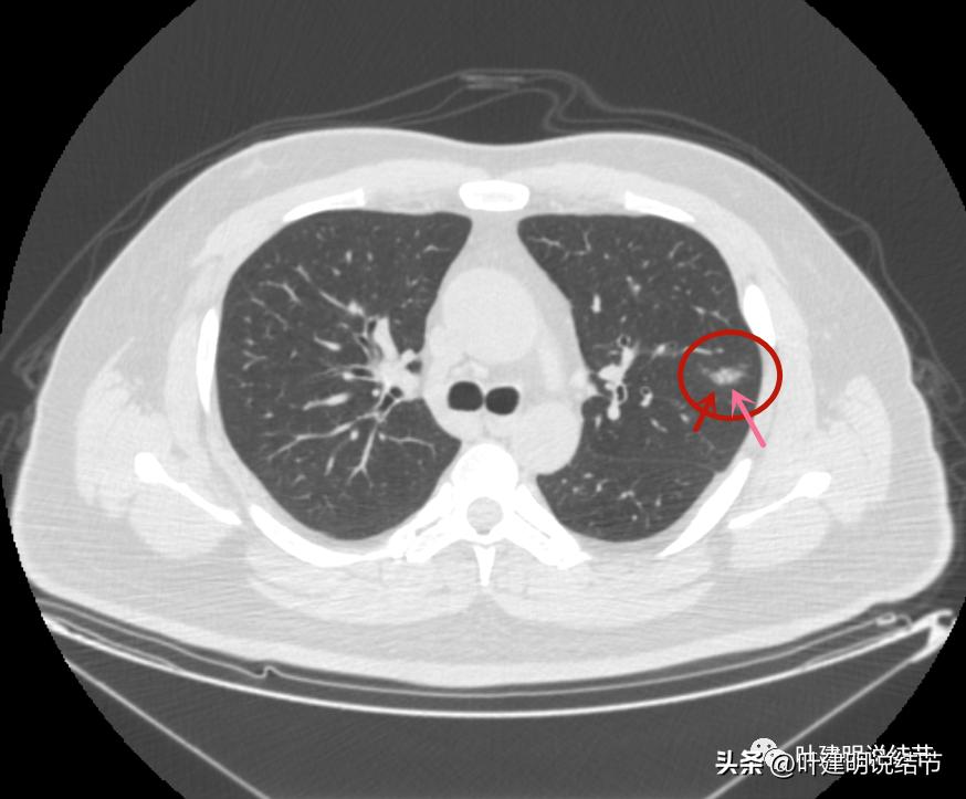 如何判断肺磨玻璃结节是高危结节,肺上有混合磨玻璃结节要注意什么