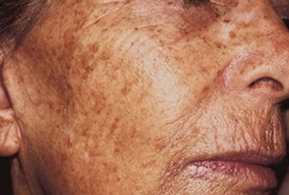 红霉素软膏可以去除老年斑么,红霉素软膏能够去除老人斑