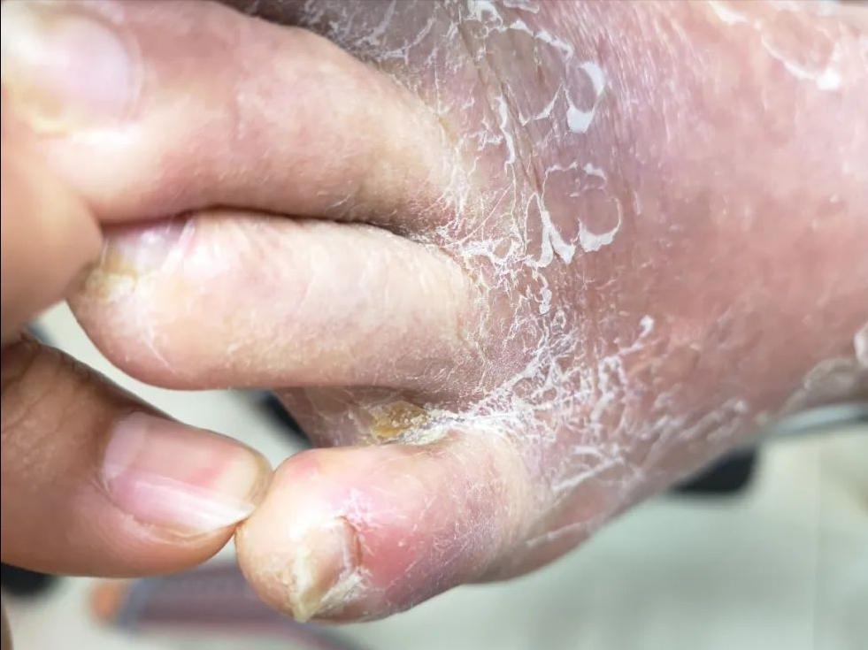 血栓引起的脚趾头坏死,脉管炎脚趾头坏死化脓