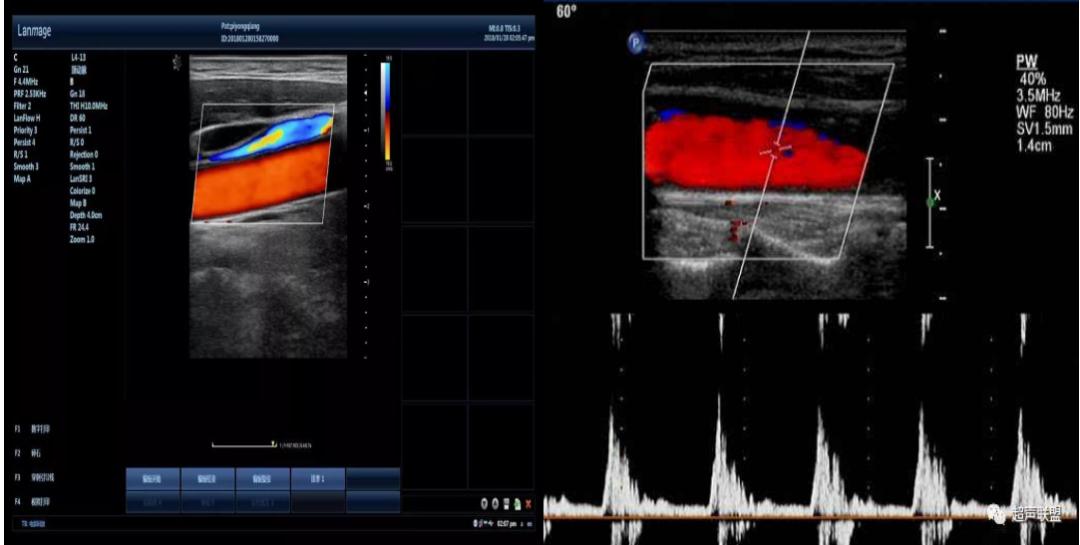 相对于黑白超声，彩超能检查出什么疾病？