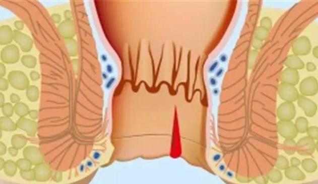 为什么会出现肛裂这样的情况,肛裂为什么女性居多