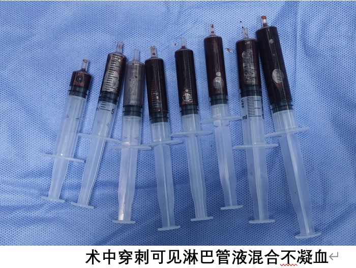 儿童腋下淋巴管瘤介入微创治疗病例