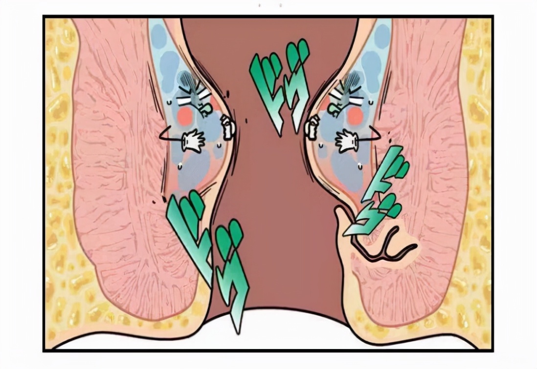 肛门潮湿瘙痒有臭味应怎么治疗,肛门潮湿瘙痒有异味怎么治疗