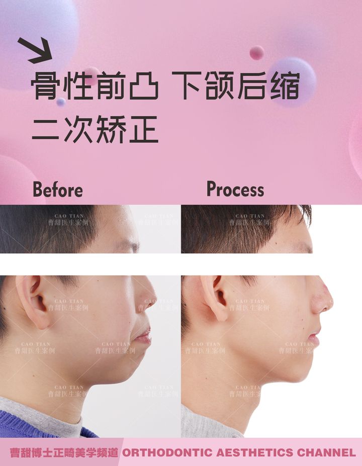 凸嘴下巴后缩拔牙改善有什么坏处,深覆合嘴凸下巴后缩矫正要拔牙吗