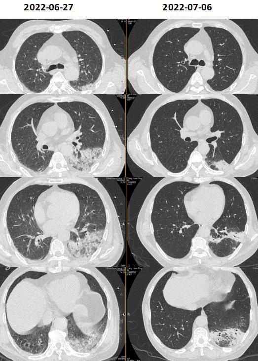 发热十多天了输液吃药还是发热,脓毒症高烧不退