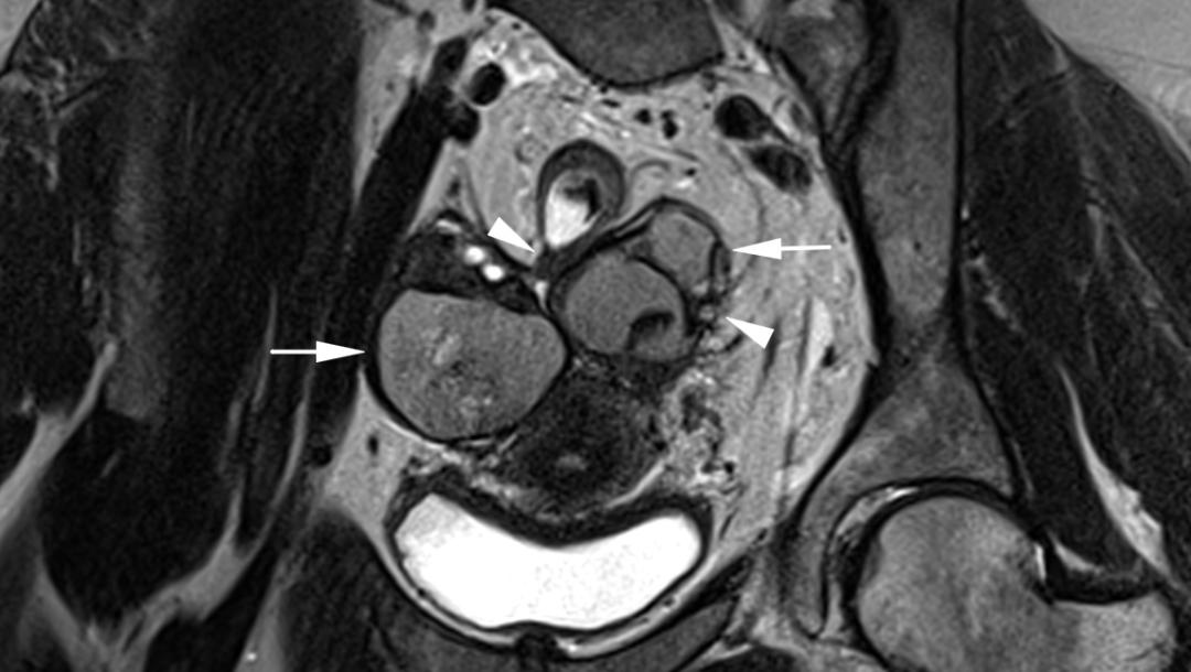 MRI如何评估子宫内膜异位症？这10个病例会帮助您