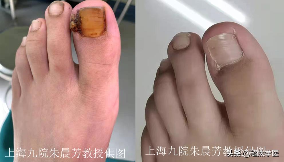 指甲受伤导致嵌甲,指甲增厚引起嵌甲修复