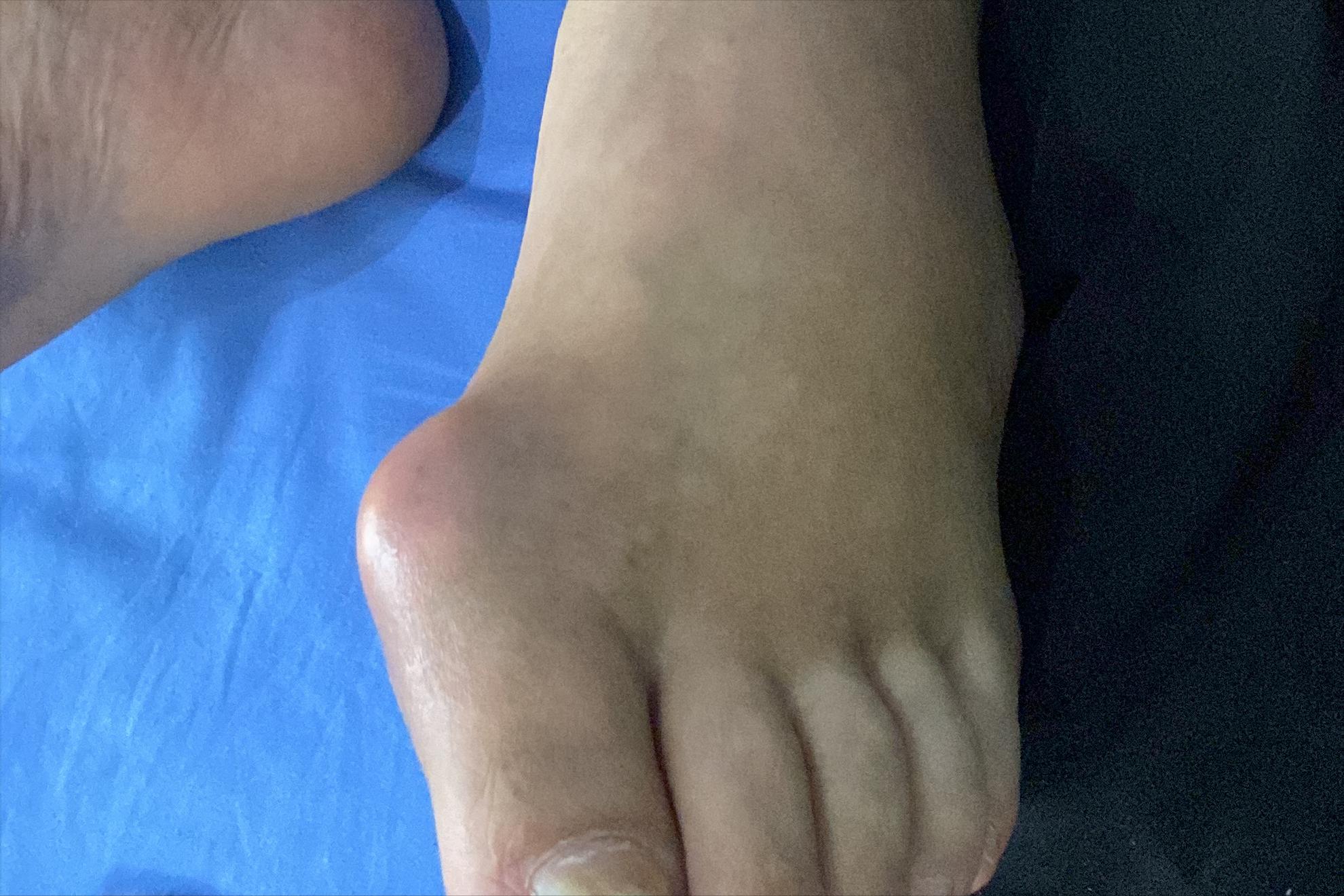 痛风怎样才能彻底把尿酸降下来,痛风止痛且能降尿酸的草药