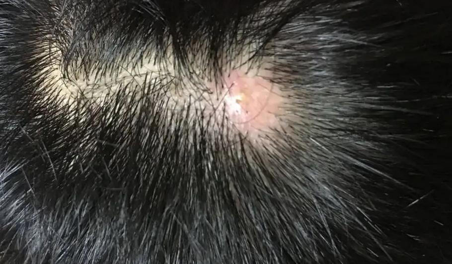 头皮经常长疙瘩什么原因,头皮经常长疙瘩用什么药