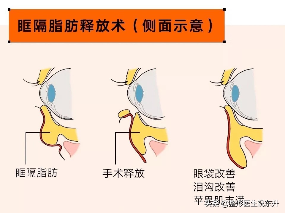 做眼袋外切手术真实经历,做眼袋手术大概需要多少钱安全吗