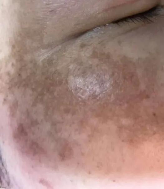 去脸上色斑,色斑怎么判断是哪种斑