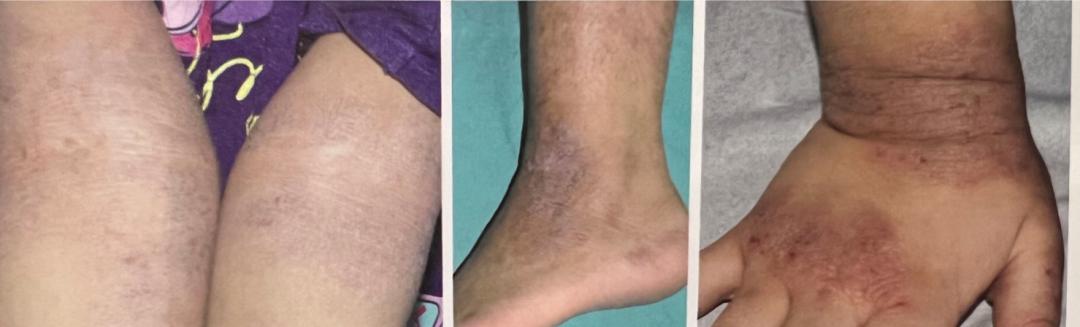 特应性皮炎中医疗法,特应性皮炎忌口食物一览表