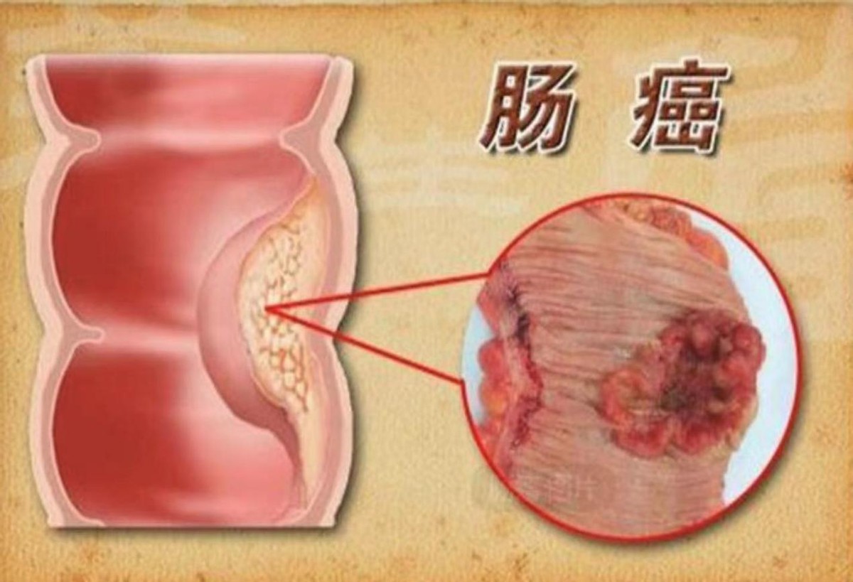 牛肉是致癌还是营养,牛肉是好还是坏吃多是否会致癌