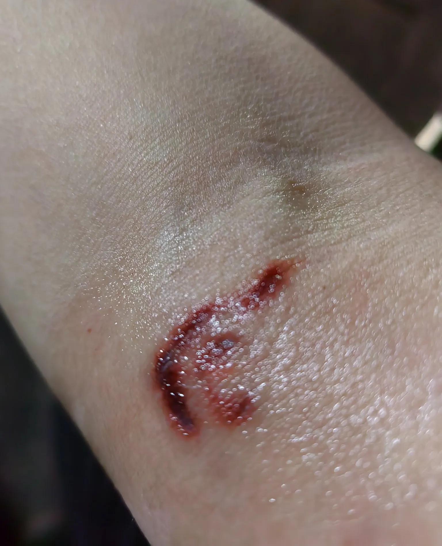 养狗人是怎么处理被狗咬到的,养狗被自家狗咬伤了怎么办