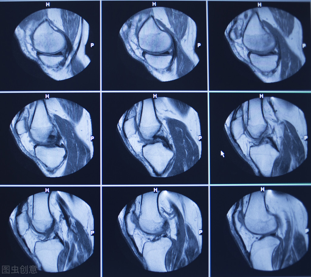 诊断半月板损伤的实验方法,膝关节半月板损伤鉴别诊断